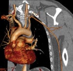 cardiac CT, cardiovascular computed tomography, what to look for in a CT scanner, advances in CT