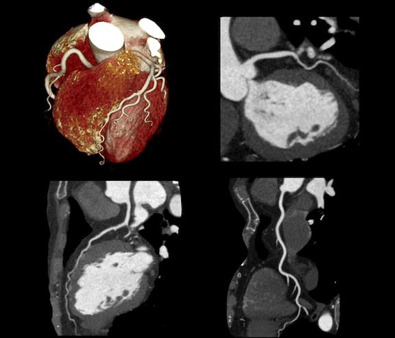 Cardiac coronary computed tomography angiography (CCTA) exam showing different views of the myocardium and the coronary arteries. This was scanned on a Canon Aquilion Prime CT scanner.