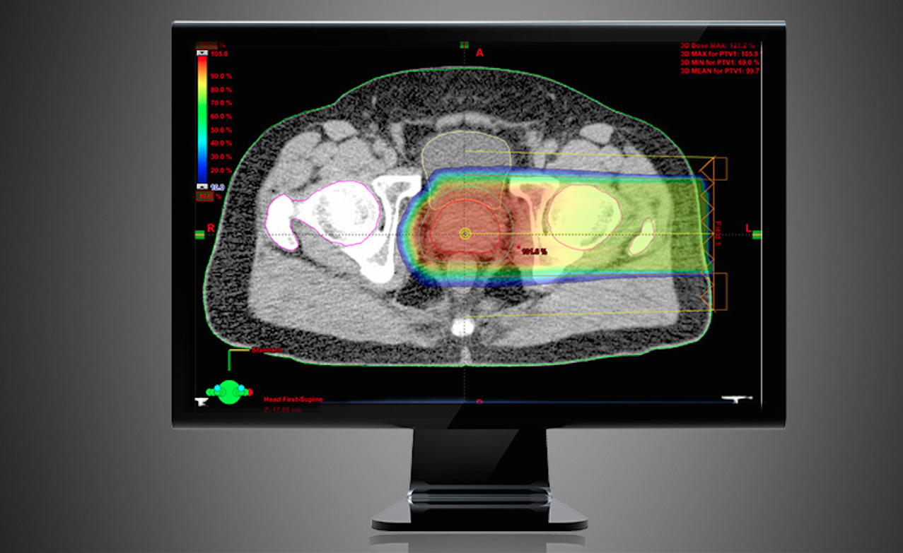 proton treatment planning, prostate