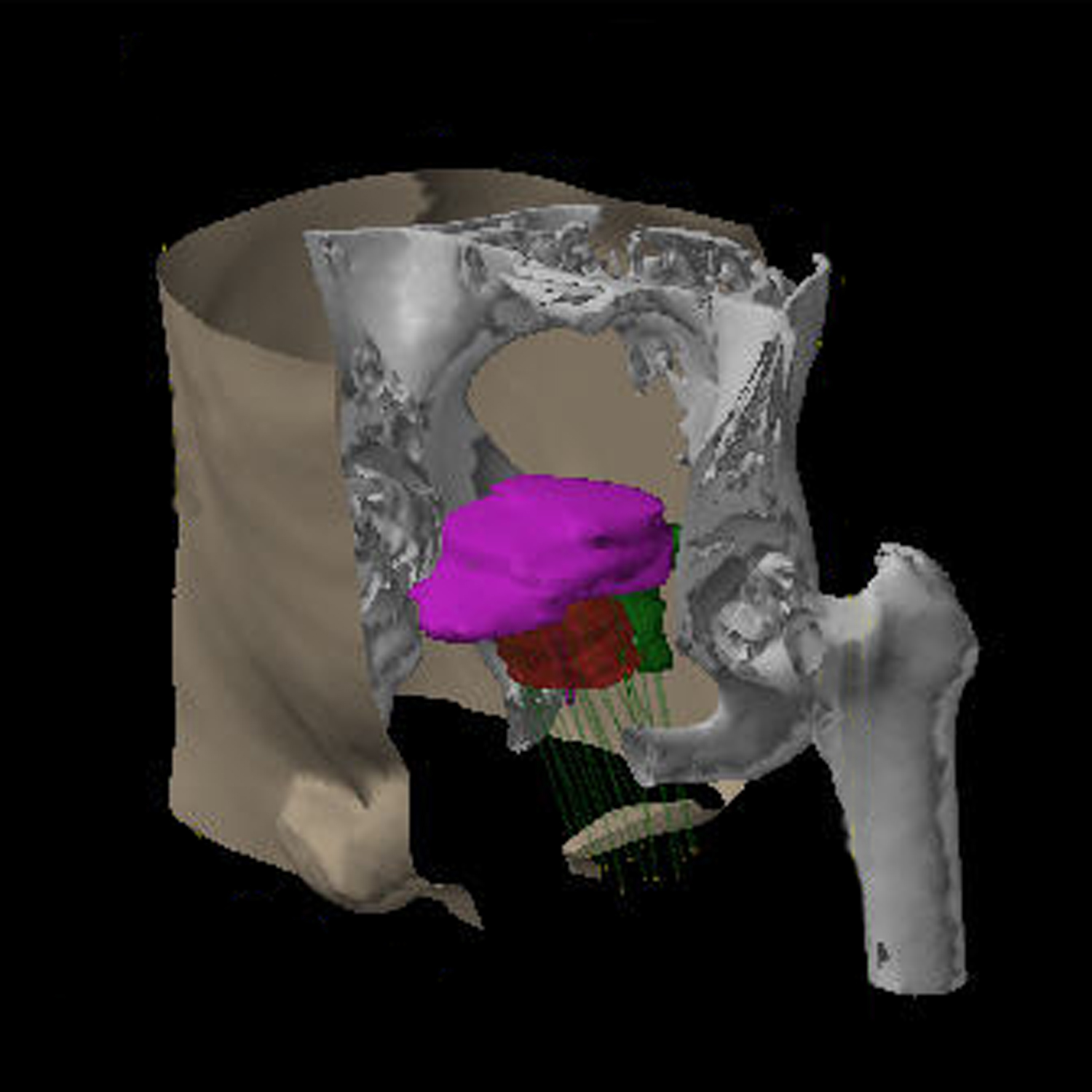 Varian Vitesse Brachytherapy Systems evine Cancer Institute