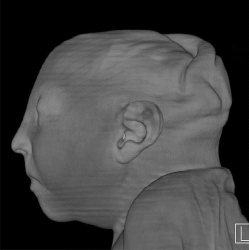 Zika virus, imaging zika, CT scans of Zika, MRI scans of zika, radiology of Zika, medical imaging of zika