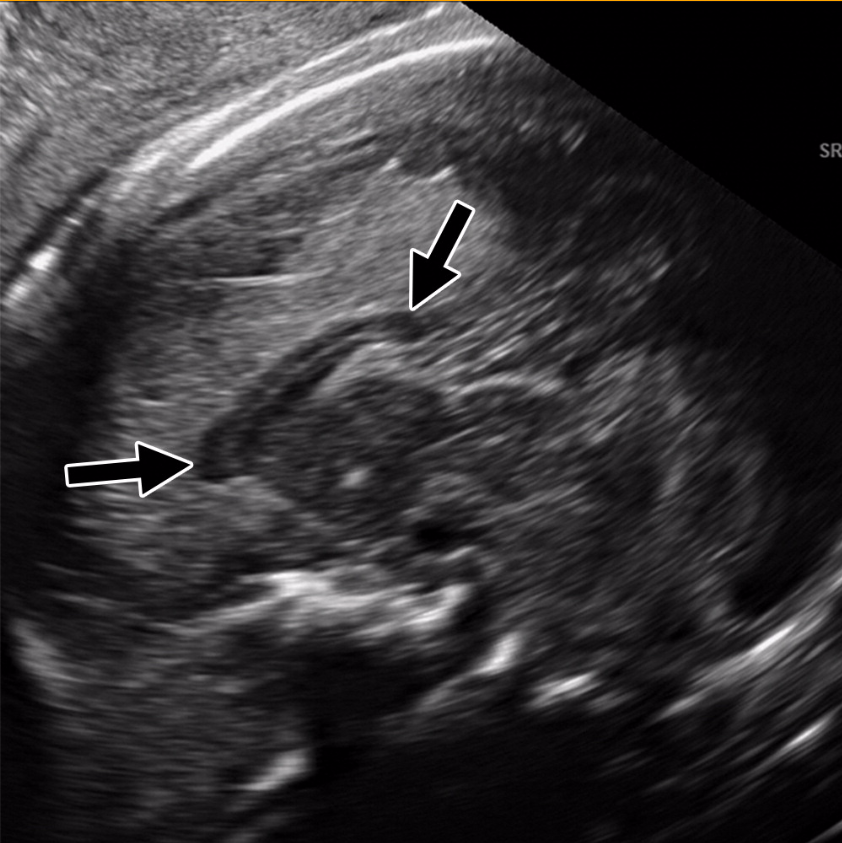 Zika virus, imaging zika, CT scans of Zika, MRI scans of zika, radiology of Zika, medical imaging of zika