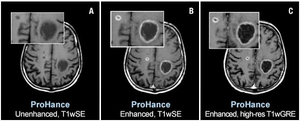 Two brain metastases from primary lung cancer are contrast enhanced in the brain of a 61-year-old male. Speakers at AHRA 2019 will state that ProHance and other macrocyclic MR agents present a very low risk to patients. Images courtesy of Bracco