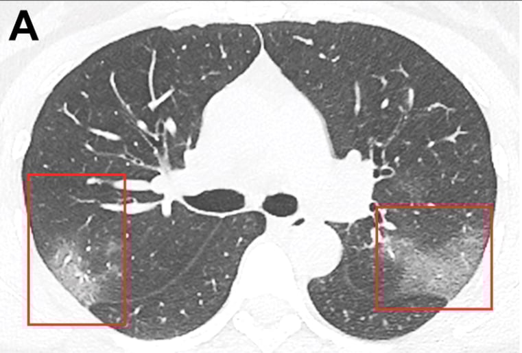 Ct Imaging Of The 19 Novel Coronavirus 19 Ncov Pneumonia Imaging Technology News