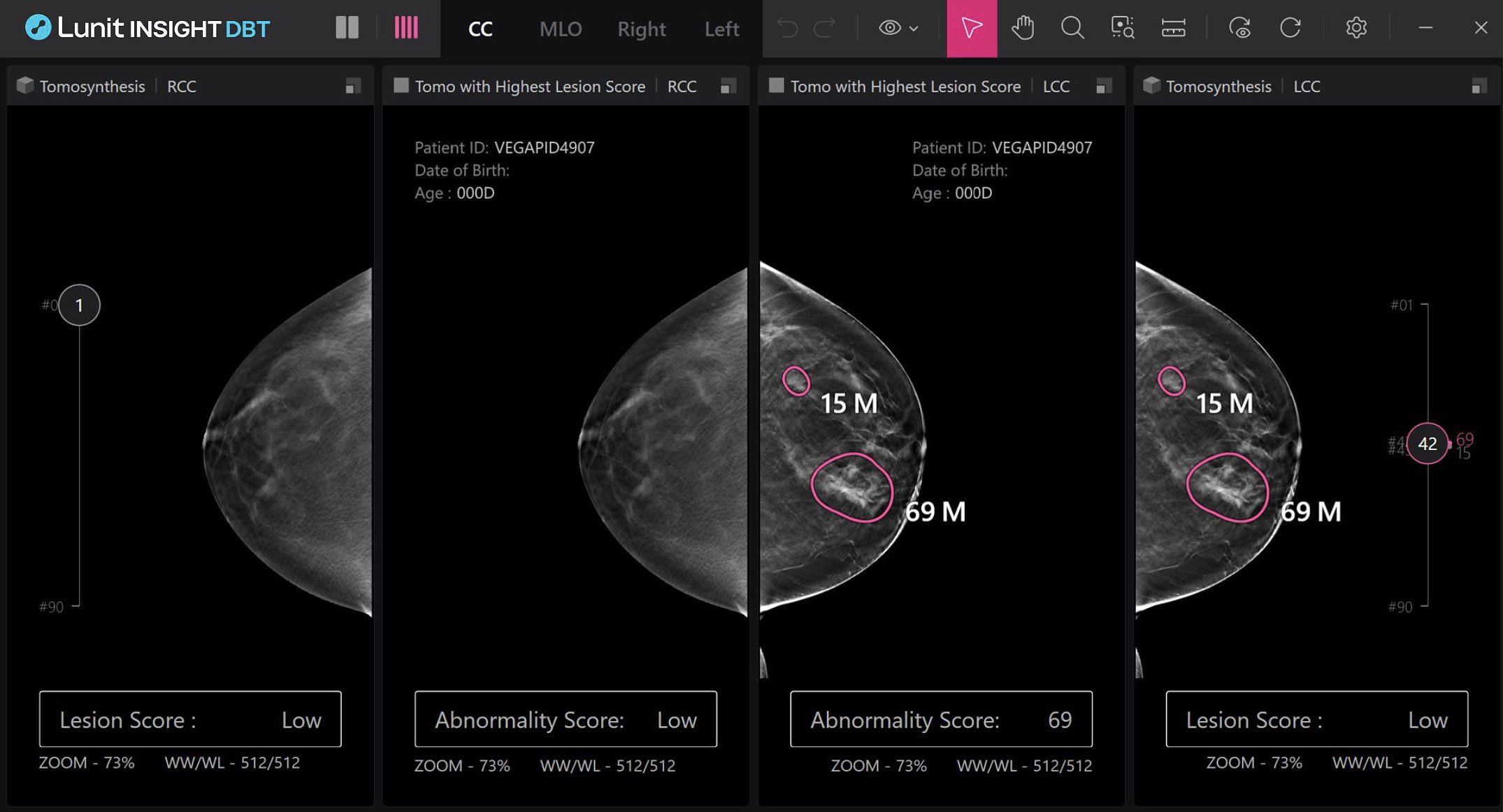 Revealing the Hidden Threat: How AI is Changing the Story of Interval Breast Cancers