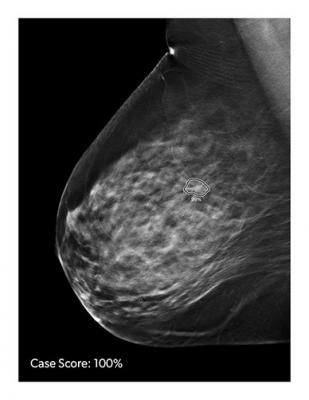 CAD's ProFound AI Improves Efficiency and Accuracy in Breast Cancer Detection