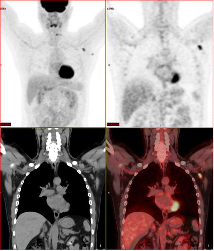 A 63-year-old multiple #myeloma patient, with skeletal pain. New #FDG avid axillary #lymphadenopathy 62 days (9 weeks) after second #mRNA #vaccination dose. Image used with permission of the Radiological Society of North America (#RSNA)