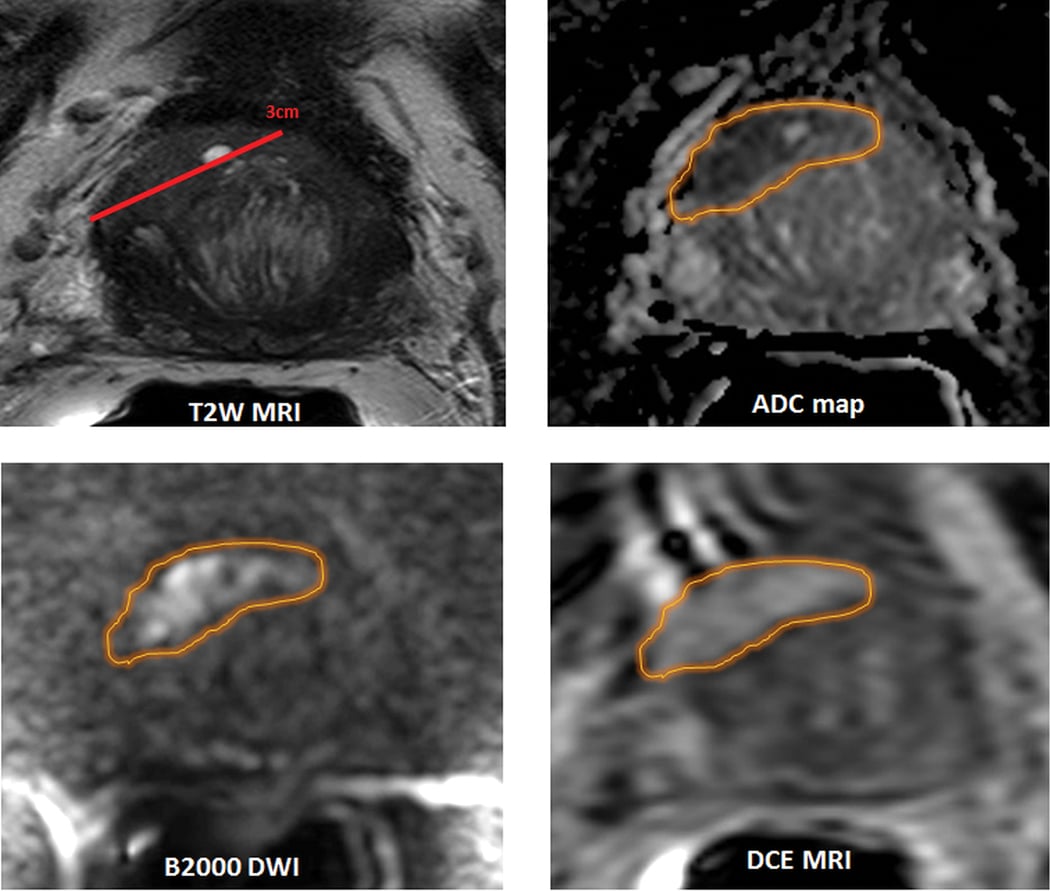 how to read prostate mri glükózamin és kondroitin kiegészítők