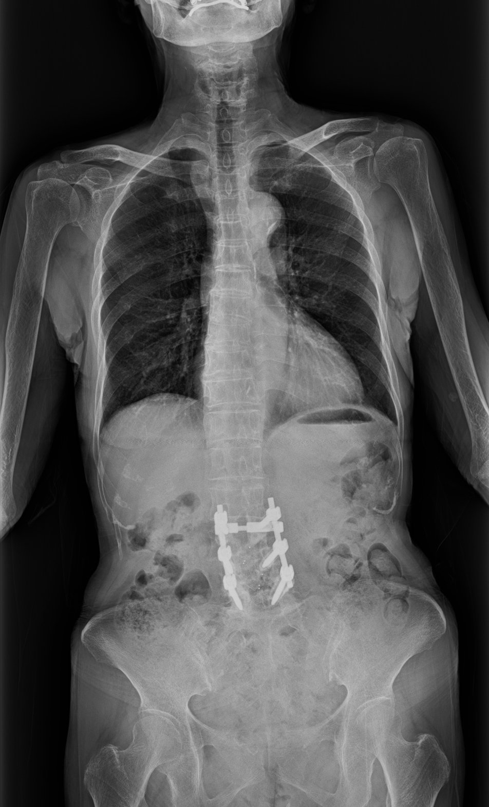 Advances in long-length digital radiography are creating opportunities for visualization during spinal surgery, as well as pre- and post-operatively. Image courtesy of Fujifilm Medical Systems