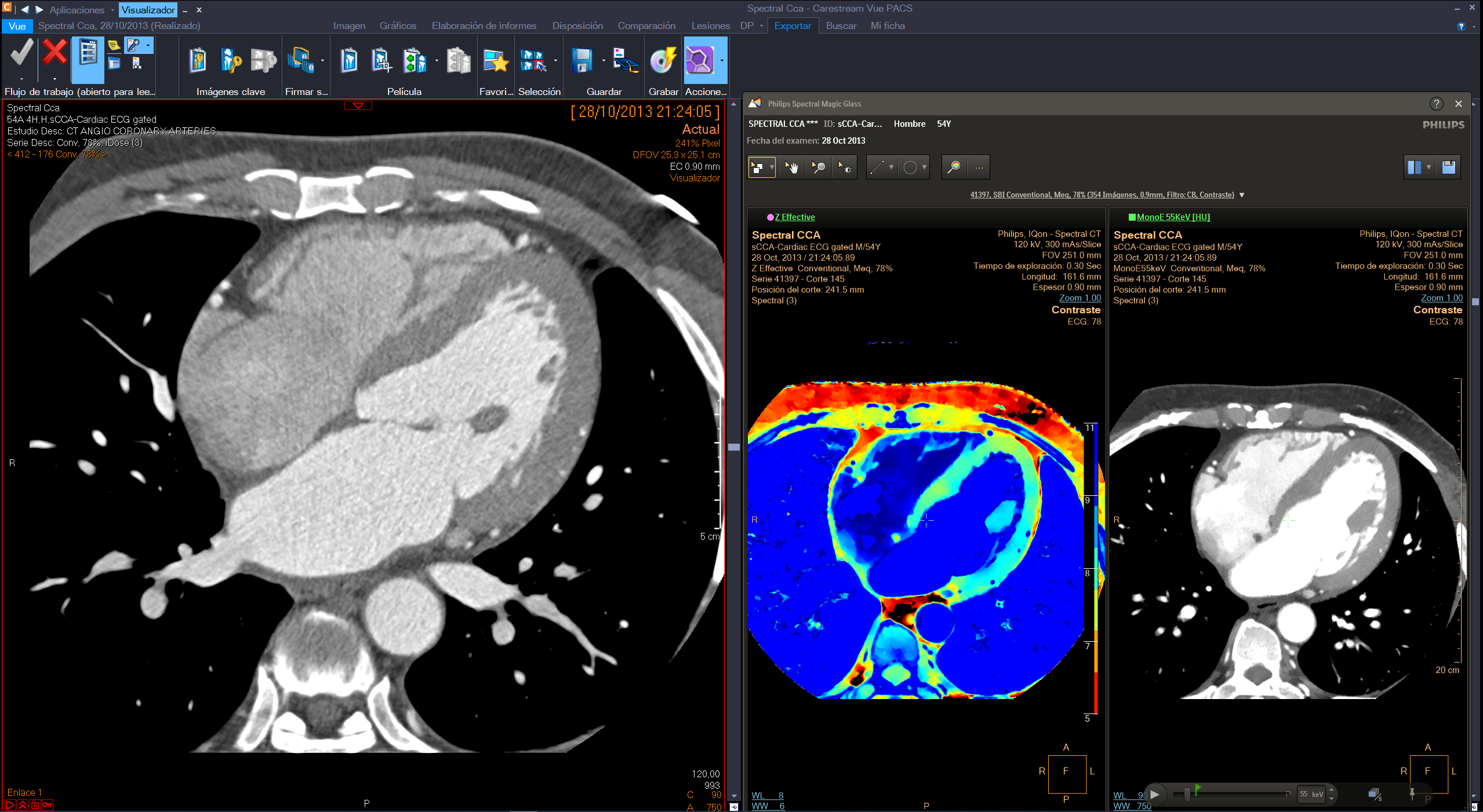 Philips integrated the IntelliSpace Portal advanced applications with the Philips diagnostic viewer (from Carestream) creating a combined radiology diagnostic workspace.