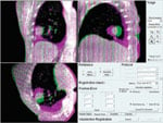 symmetry baseline shift, elekta treatment plan, VMAT, tomotherapy