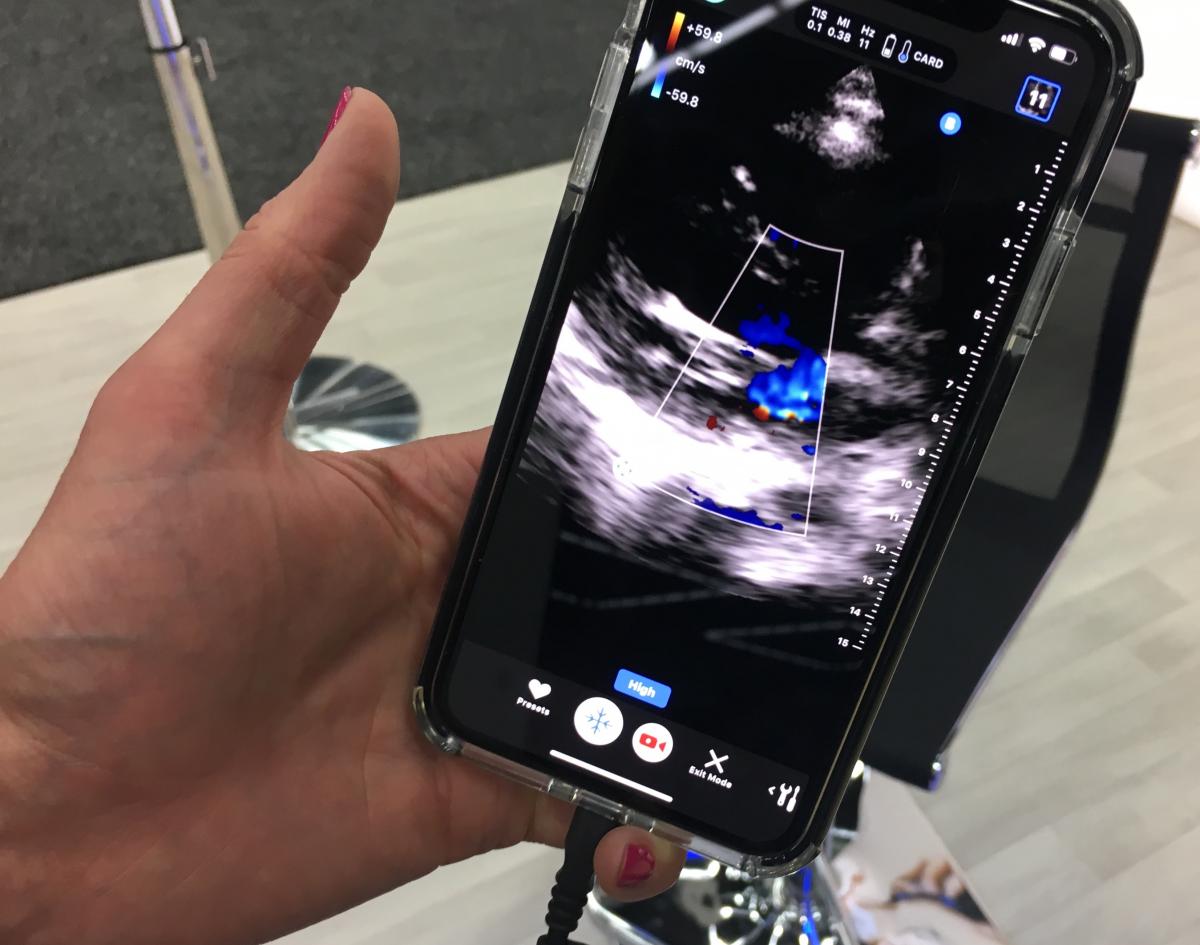 This is an iPhone being used with the Butterfly transducer and app to perform a basic POCUS cardiac exam.
