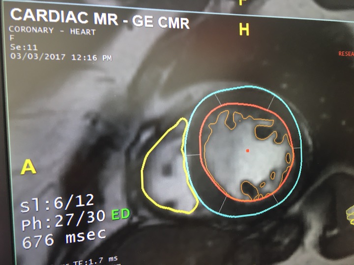 TeraRecon's Envoy AI marketplace offers apps from several third-party AI start up companies in one location. This is an example of AI available through Envoy to automate cardiac MRI analysis.