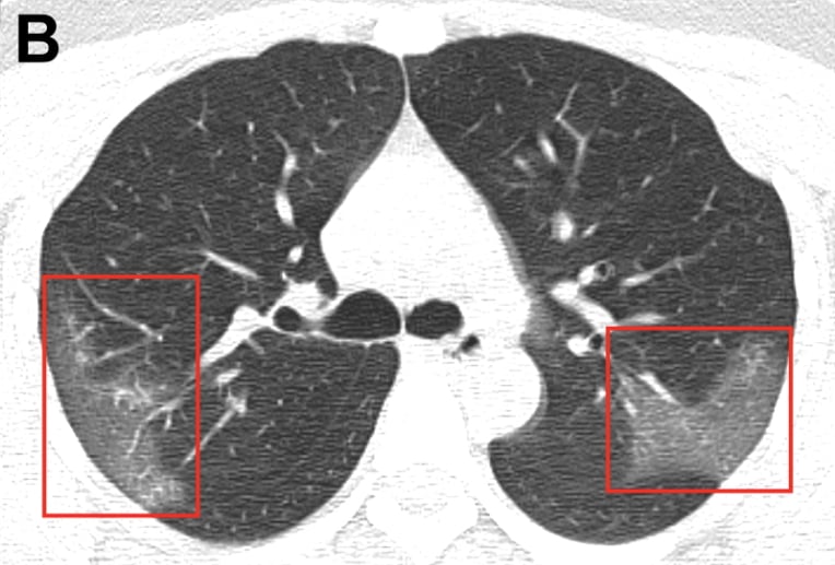 Figure B of a CT scan of a coronavirus patient in China. It shows ground glass lesions in the lungs.