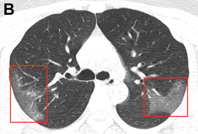 Ct Imaging Of The 19 Novel Coronavirus 19 Ncov Pneumonia Imaging Technology News