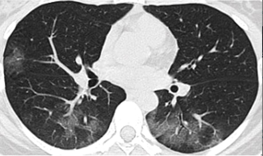 CT lung imaging from a 41-year-old woman who tested positive for the 2019 novel coronavirus (2019-nCoV) showing multifocal ground glass opacities without consolidation. Image is from Journal Radiology. 