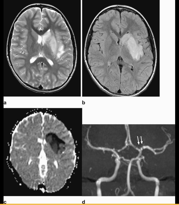 Figure 1: Axial T2-weighted (a) and FLAIR (b) Magnetic resonance imaging show diffuse hyperintense signal and edema of the caudate nucleus head, putamen, anterior limb of the internal capsule, and parts of external capsule and insula on the left side, with corresponding low values on the axial apparent diffusion coefficient map, in keeping with an acute infarct. Time-of-flight magnetic resonance angiography maximal intensity projection reformatted image demonstrates focal irregular narrowing and banding of the proximal left M1 segment of the middle cerebral artery with a slightly reduced distal flow in the middle cerebral artery.