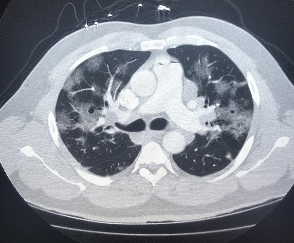 COVID-19 and the heart seen in a chest CT scan.