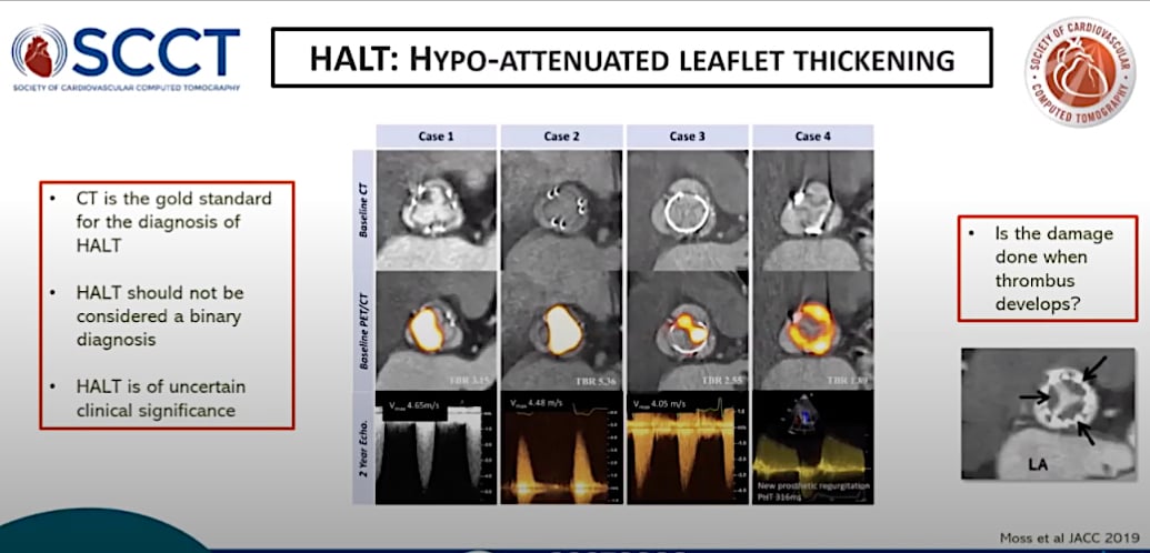 HALT on TAVR valves