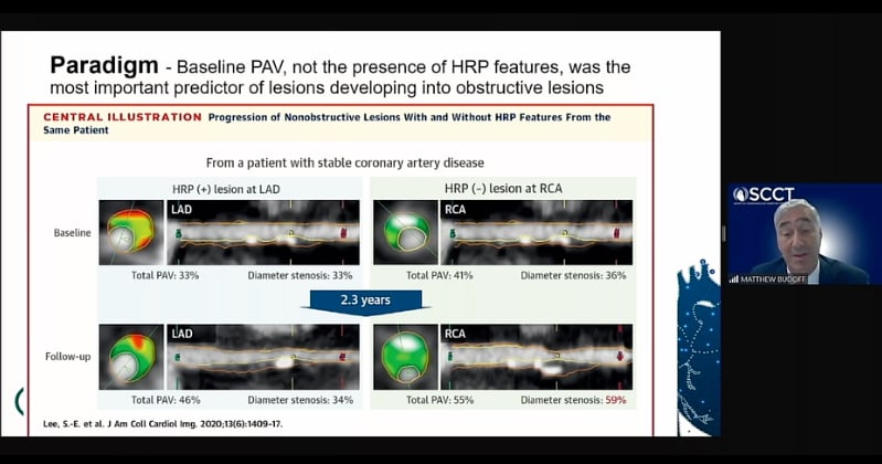 Coronary CT plaque assessment