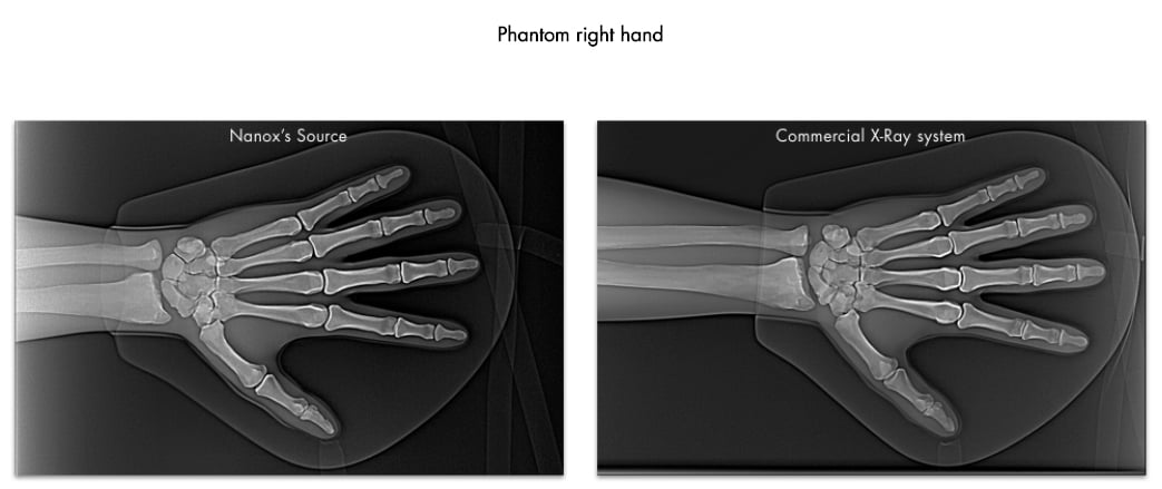 Nanox cold cathode X-ray comparison with standard X-ray tube images