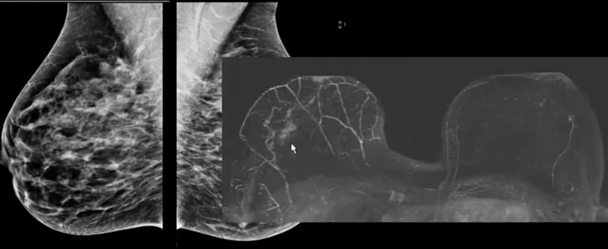Breast MRI compared to a  mammogram showing a cancer that otherwise would have been missed.