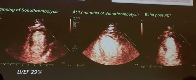 Images from a study of therapeutic ultrasound using bubble contrast agents to revascularize heart attack patients in transit to the hospital.