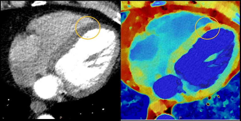 Spectral CT of a myocardial infarct.