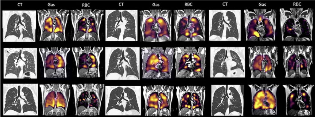 Normal lung CT scans along with xenon MRI showing problems with alveolar-capillary diffusion in 9 COVID-19 long-hauler patients three months after recovering from COVID pneumonia. There is a mismatch in the gas imaging phase (shoing concentrations of the xenon gas), and the gas uptake phase where there are numerous areas where there is gas present but it cannot be transferred to the blood due to micro-emboli. Image courtesy of RSNA.