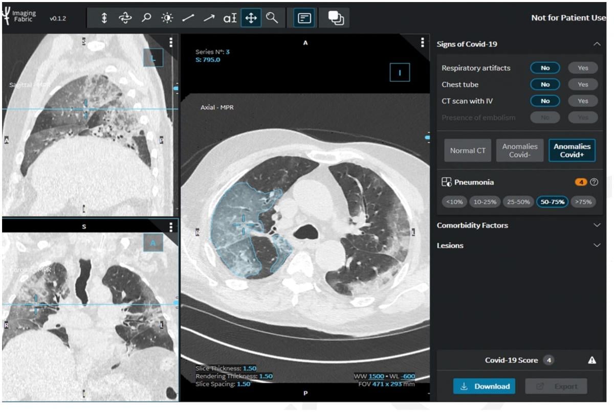 Visual quantification of COVID lung disease extent from the STOIC study CT scan.
