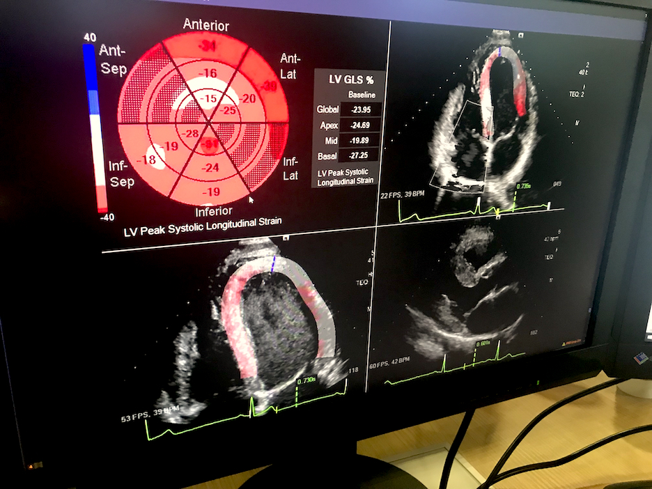 An example at HIMSS of deeper third-party software integration in enterprise imaging platforms was Siemens Healthcare showing a new, deep integration with echocardiography strain imaging analysis provider Epsilon Imaging. The integration eliminates the need for a separate login and the Epsilon software is now just a tool option available in the syngo system and it carries over data and images directly into the echo report. 