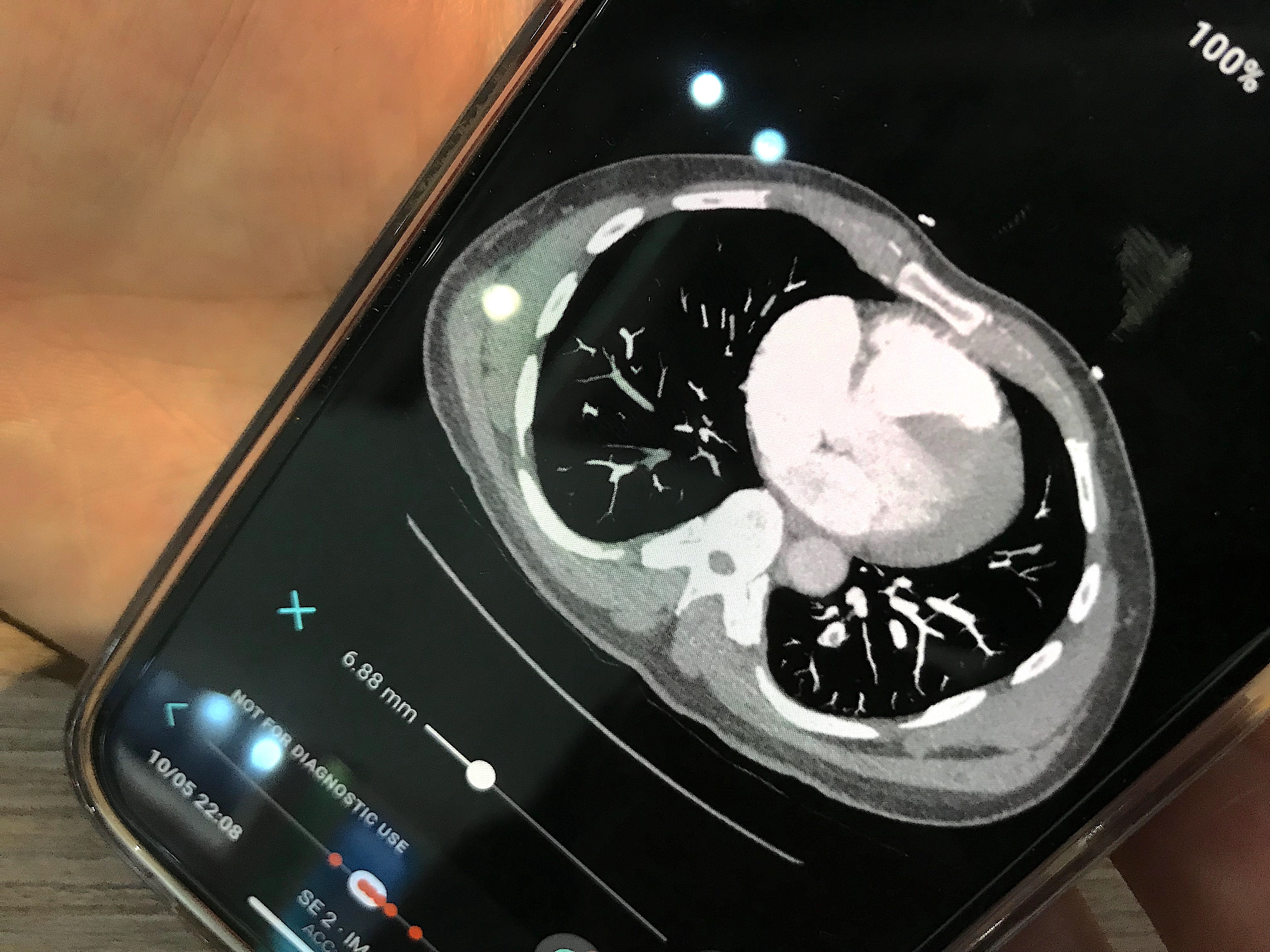 Aidoc's artificial intelligence PERT activation app showing how the CT scan can be viewed on a smartphone. The orange dots at the bottom of the page mark key slices were the AI detected pulmonary emboli. Photo by Dave Fornell