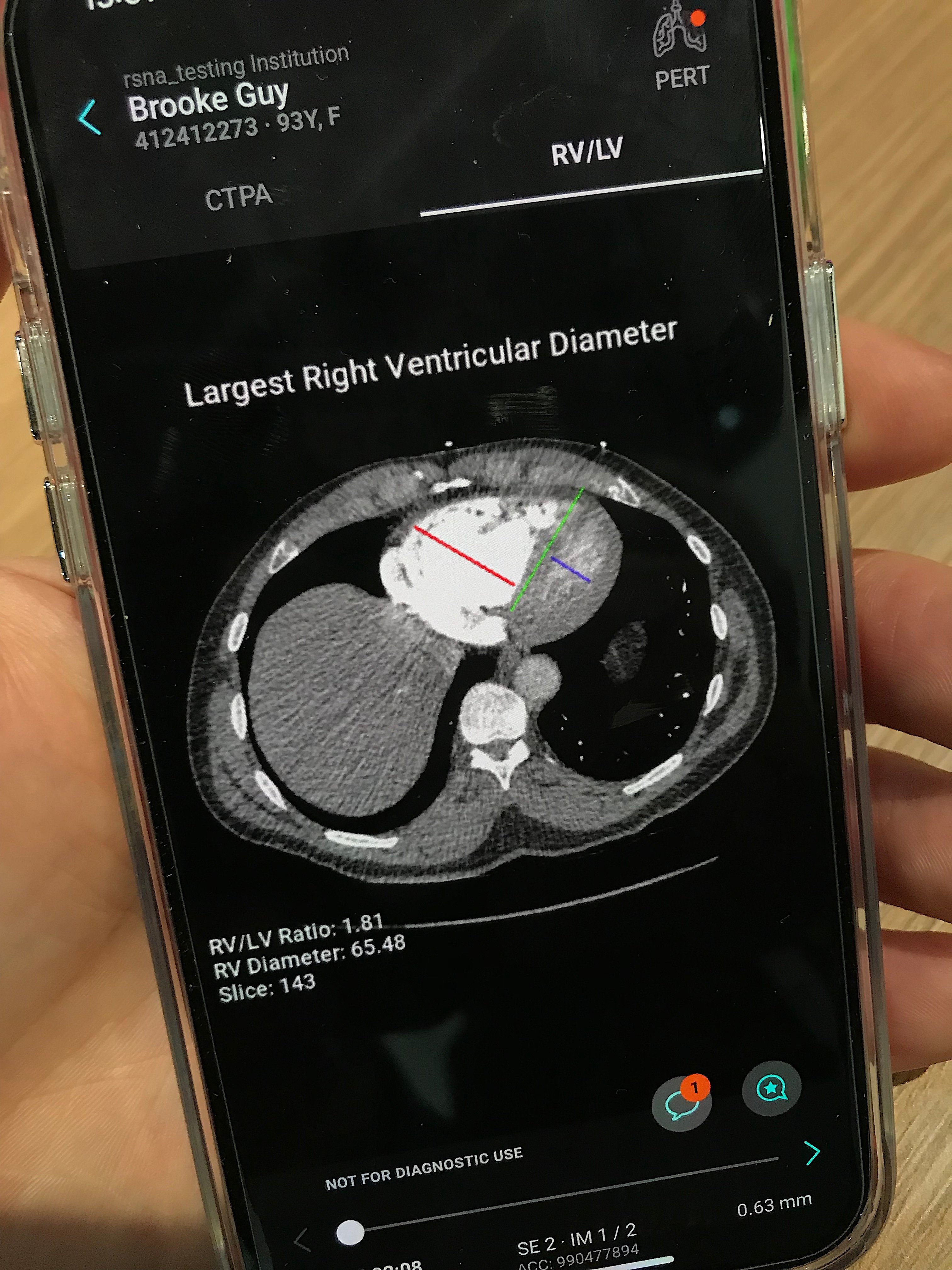 Aidoc's PERT team activation app inludes Imbio's AI RV/LV ratio assessment to help risk stratify the patient.