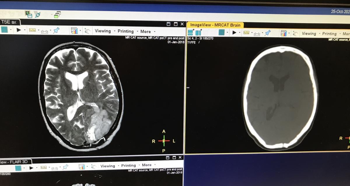 Philips synthetic CT dataset created from MRI for us in the treatment planning process without the need for an extra CT exam.