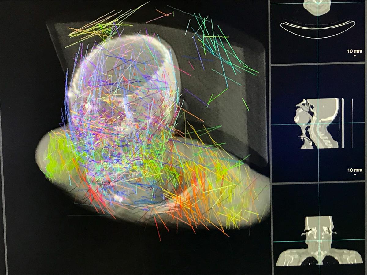 Pymedix AI Image Autofuse Registering multipe CT exams, treatment plan and contouring into one dataset. #ASTRO #ASTRO2021 #ASTRO21