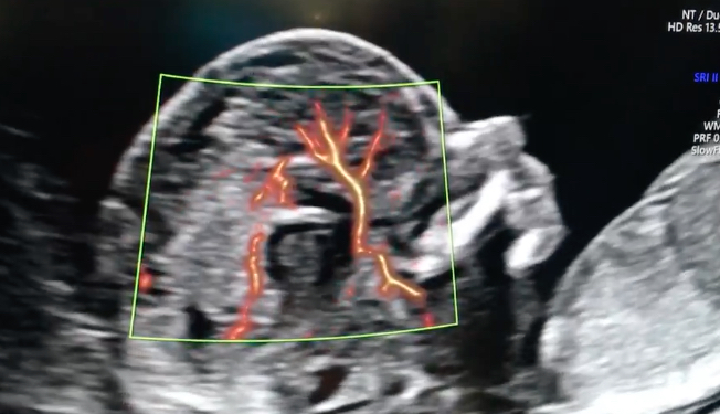 Fetal Brain Perfusion, using the HQ heart and vascular software from GE Healthcare being shown at RSNA 