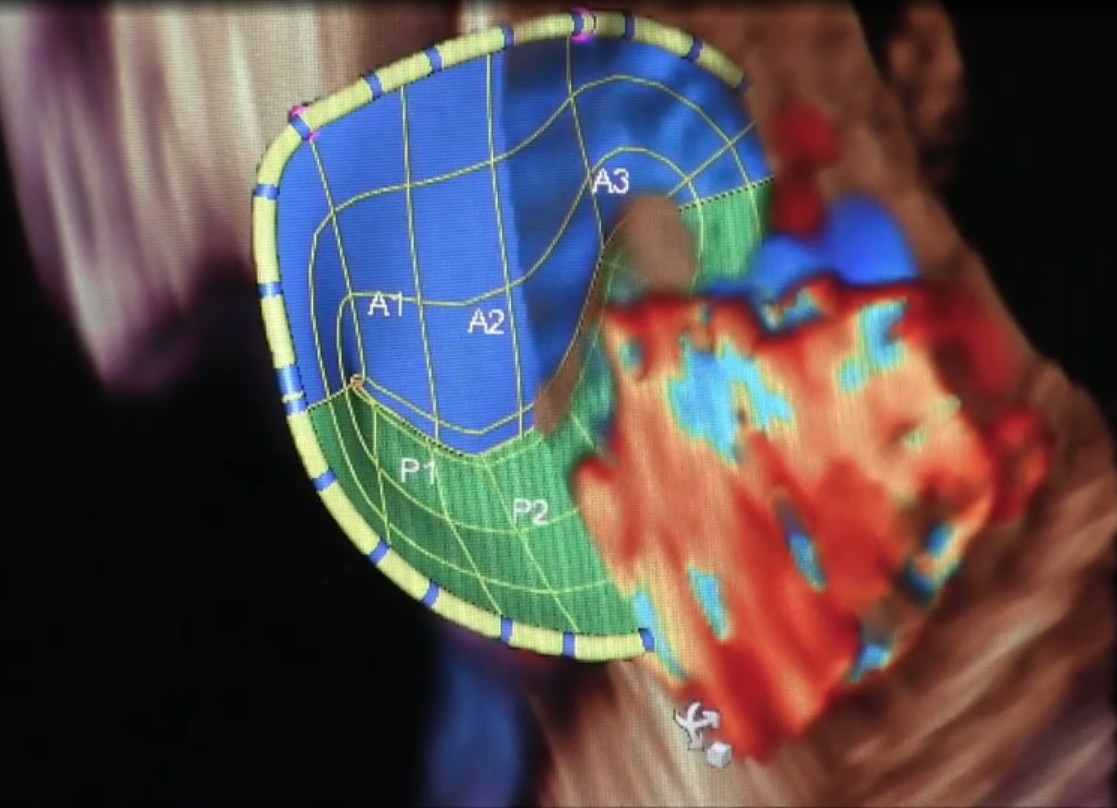 Siemens' eSie Flow valve analysis software ultrasound technology for 3-D heart valve assessments