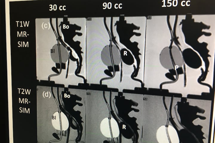 Synthetic CT images created from an MRI of a phantom at Henry Ford for radiotherapy treatment planning.