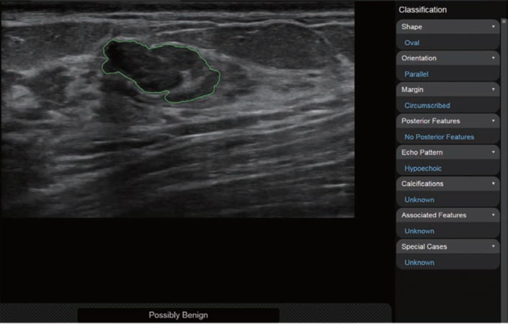 breast ultrasound2