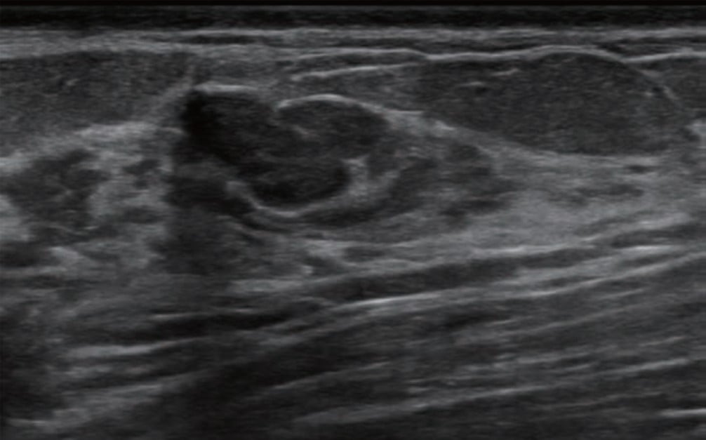 Breast Ultrasound