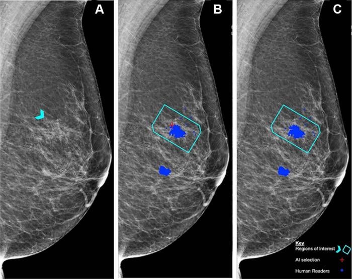 Breast imaging AI