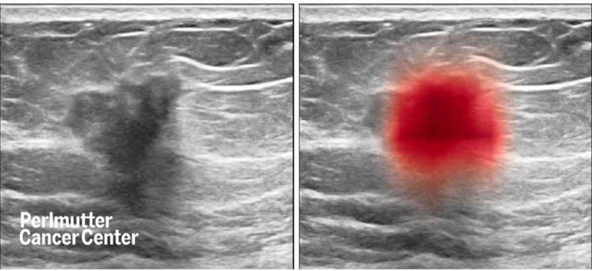 breast images