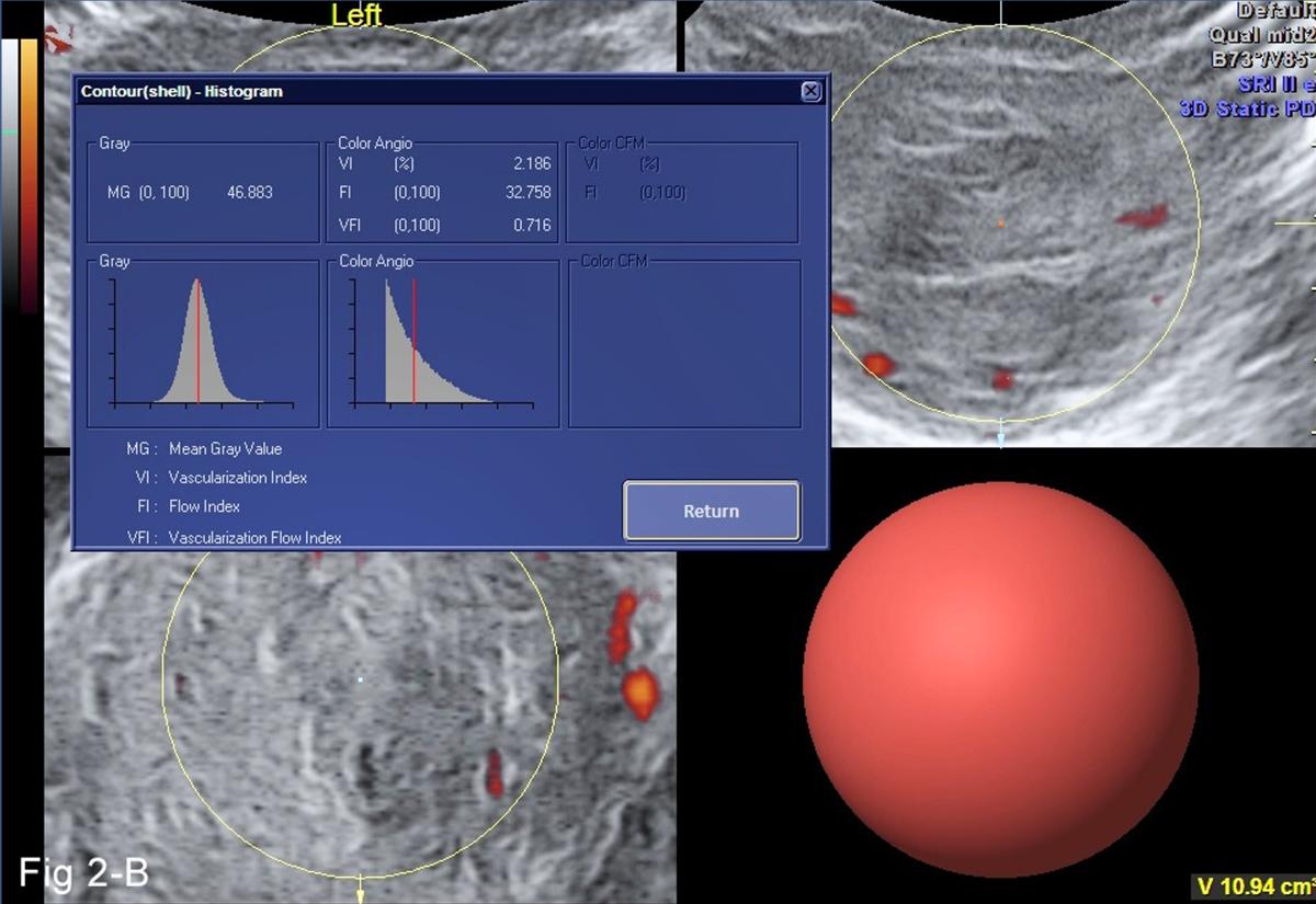 EMF treatment