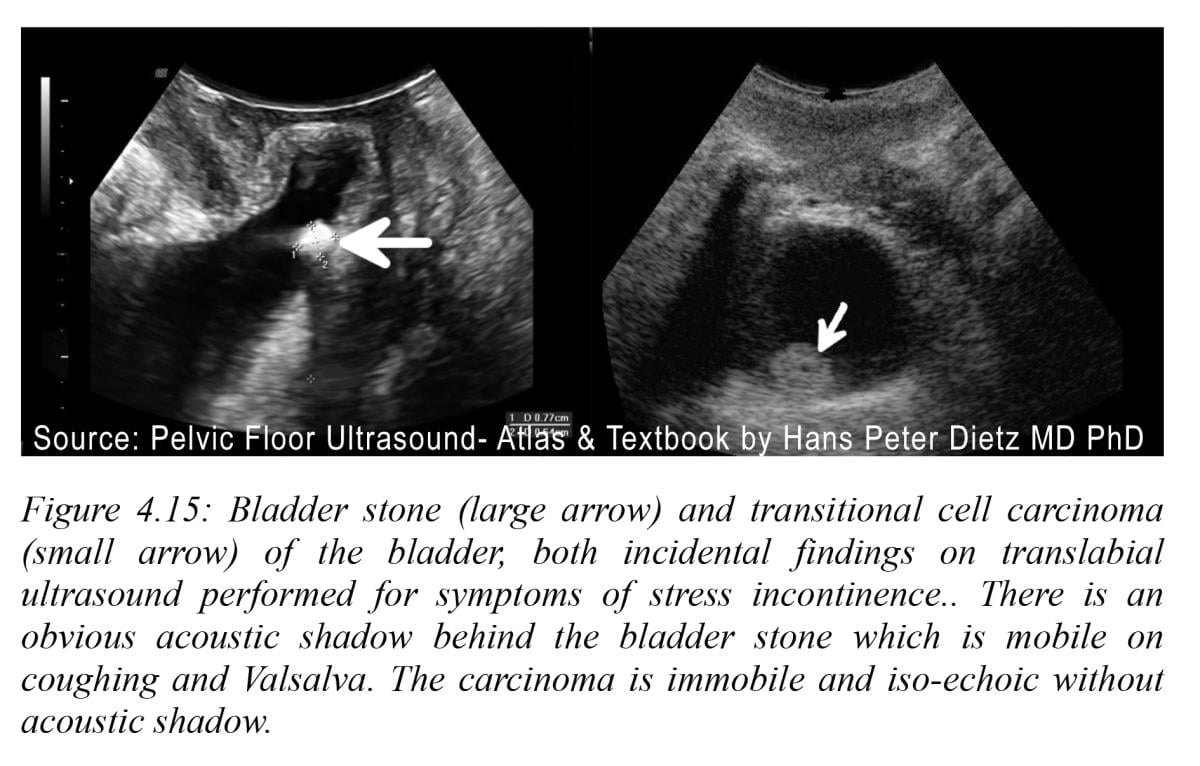 Bladder prolapse into vagina, Radiology Case