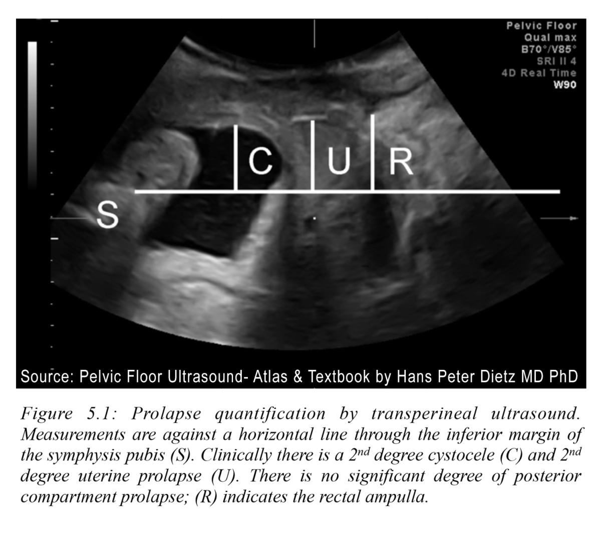 Bladder prolapse into vagina, Radiology Case