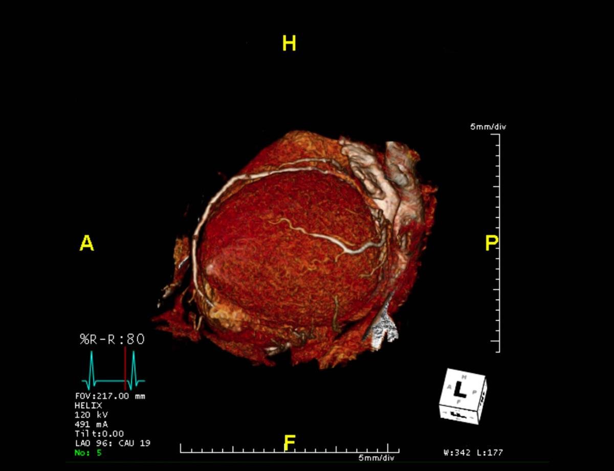 CTA Coronary artery 3-D rendering image from the screen. 