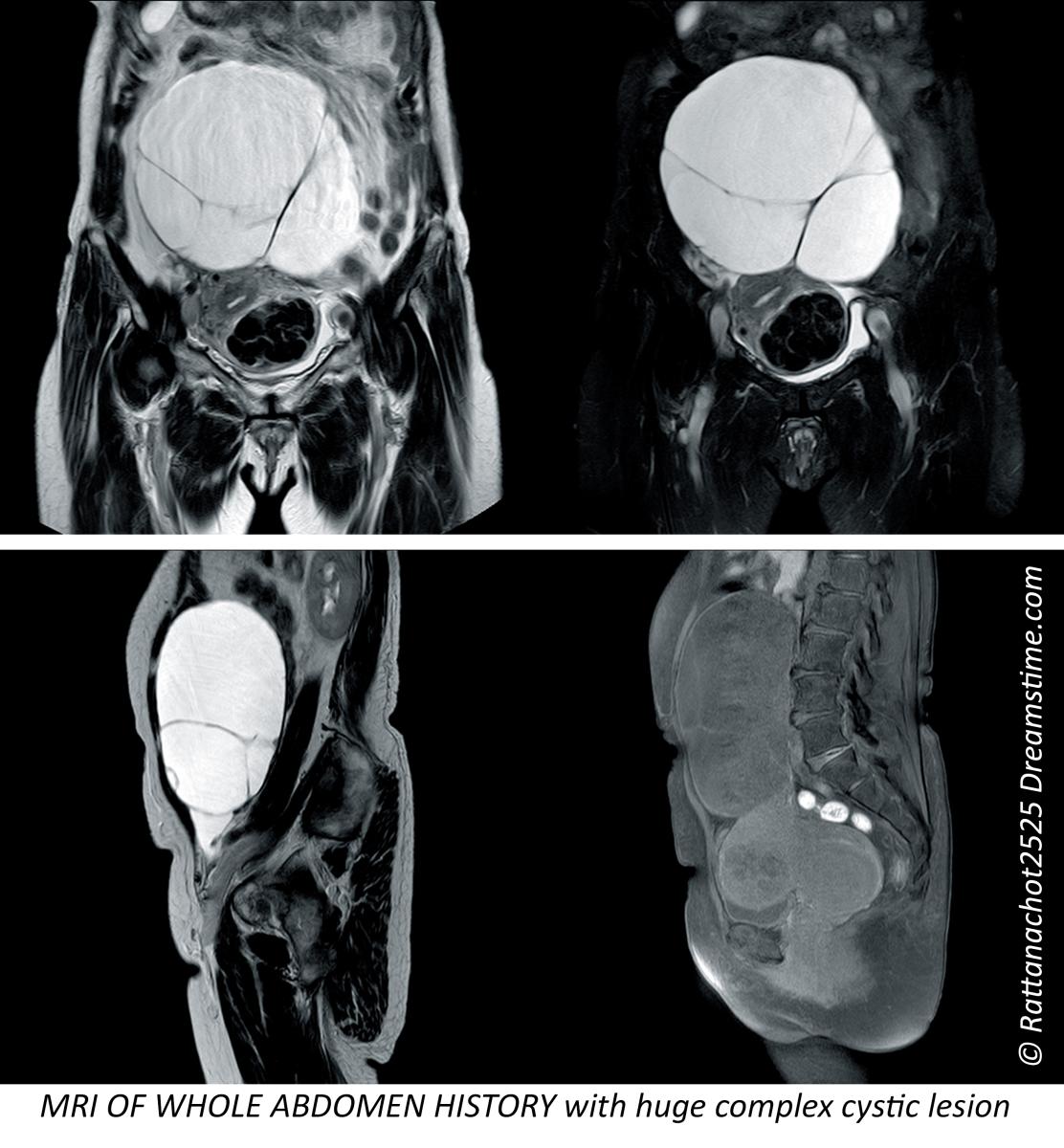 MRI