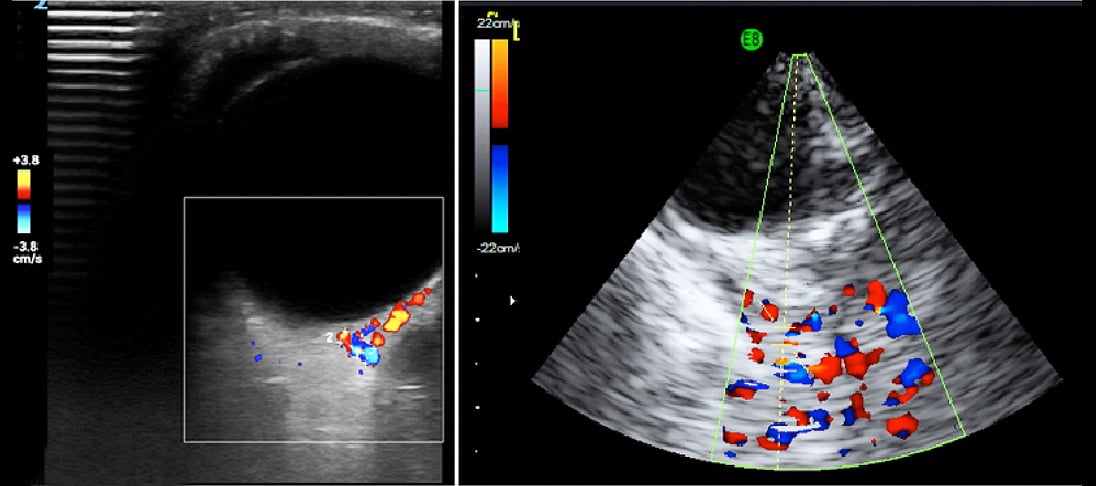 Doppler Ultrasound