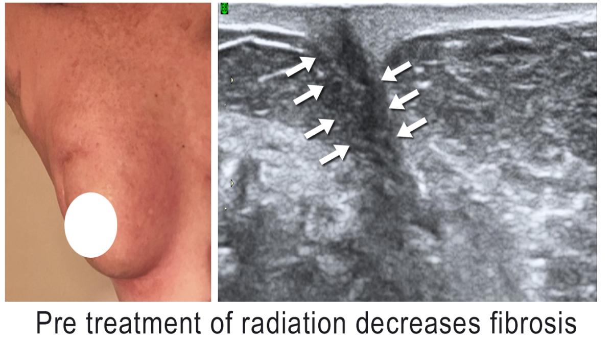 Orchietectomy followed this recurrence documentation