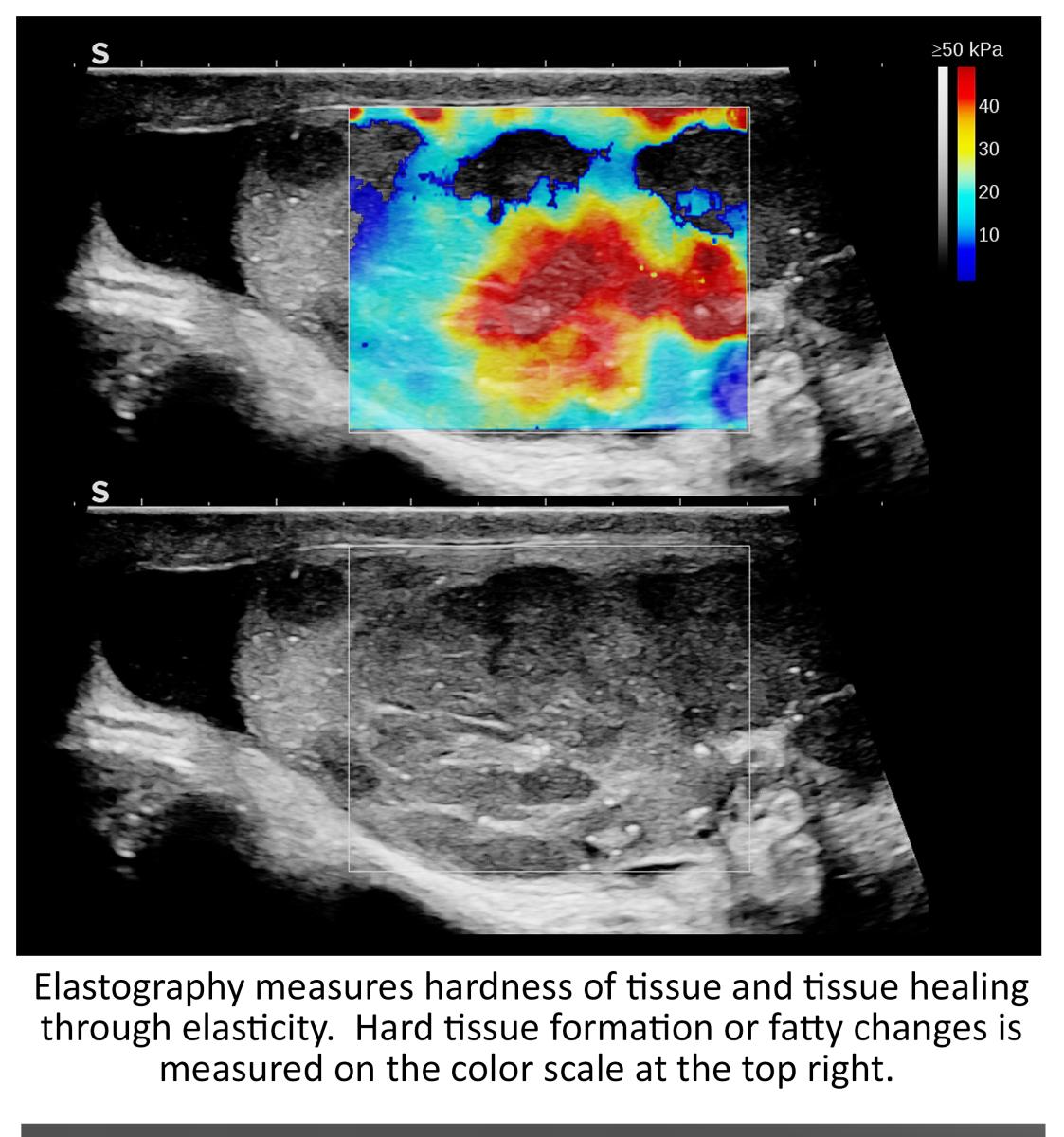 Elastography